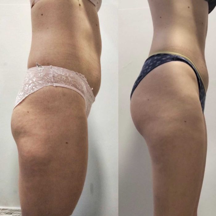 Антицеллюлитный массаж