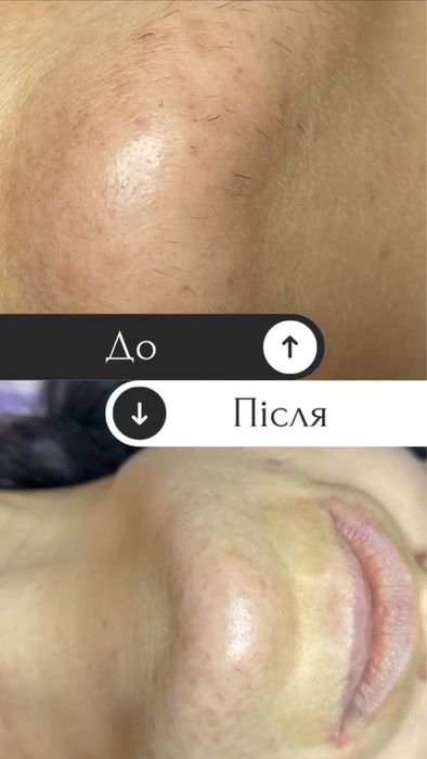 Электроэпиляция, поселок Котовского