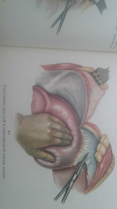 Атлас операций на печени 1975 год