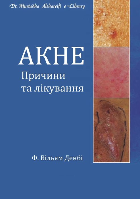 Акне. Причини та лікування Вільям Денбі 2015 р.