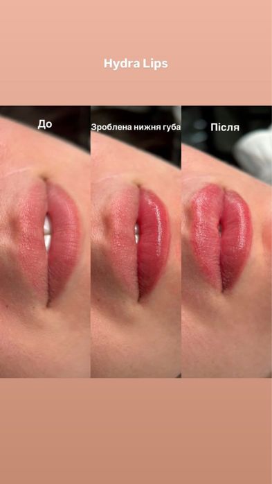 Мікронідлінг губ HYDRA LIPS - Безінʼєкційне зволоження!