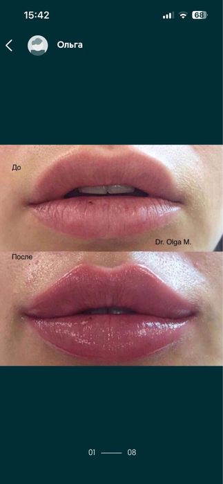 Косметолог.Ботулинотерапия от 800 гр.зона. Увеличение губ от 2000гр