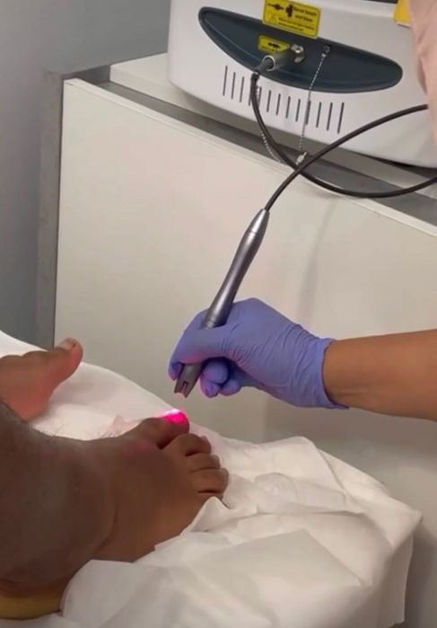 Vendo laser podologico