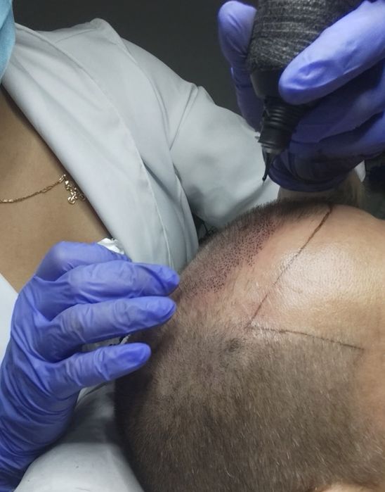 Preenchimento de barba e capilar