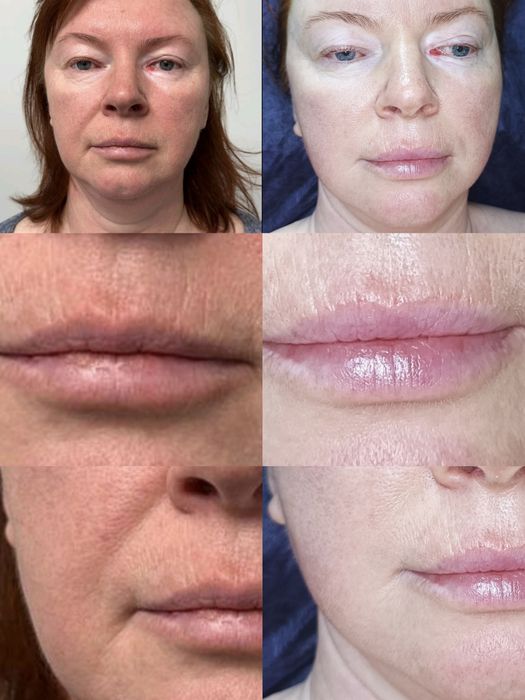 Міофасціальний,  моделюючий, лімфодренажний масаж обличчя + маска