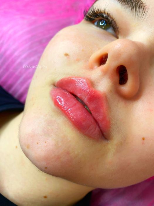 Акція! Stylage M / Контурна пластика губ /увеличение губ