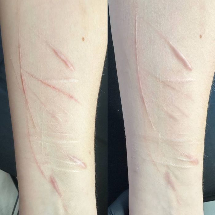 Мікронідлінг,мезотерапія обличча,рук,видалення рубців,шрамів,розтяжок