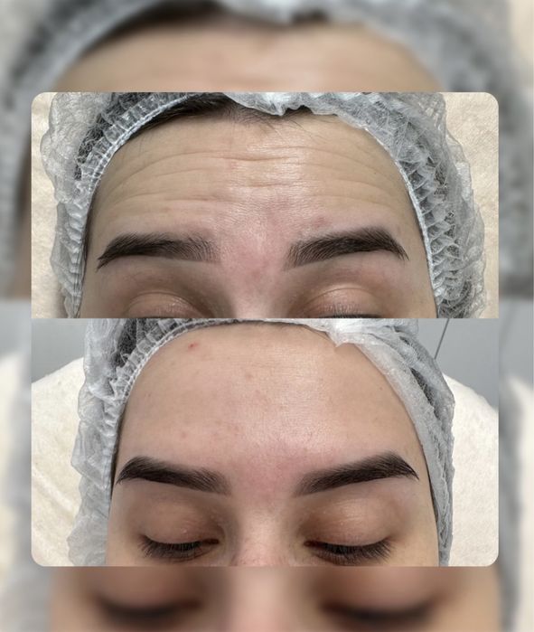 Ботулінотерапія по собівартості, модель ботокс від 500 грн АКЦІЯ