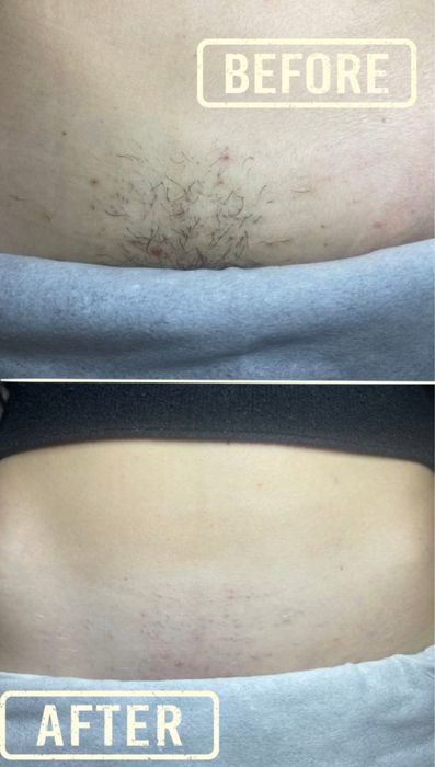 Электроэпиляция, поселок Котовского