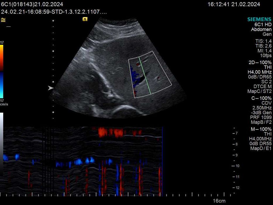 Конвексний датчик УЗД Siemens (Acuson) 6C1 HD