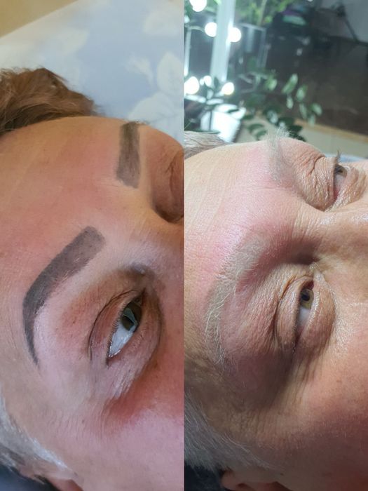 Удаление тату, Удаление татуажа, удаление перманента