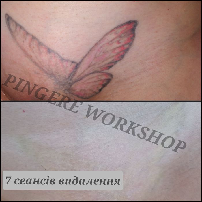 Безпечне лазерне видалення тату, татуажа.