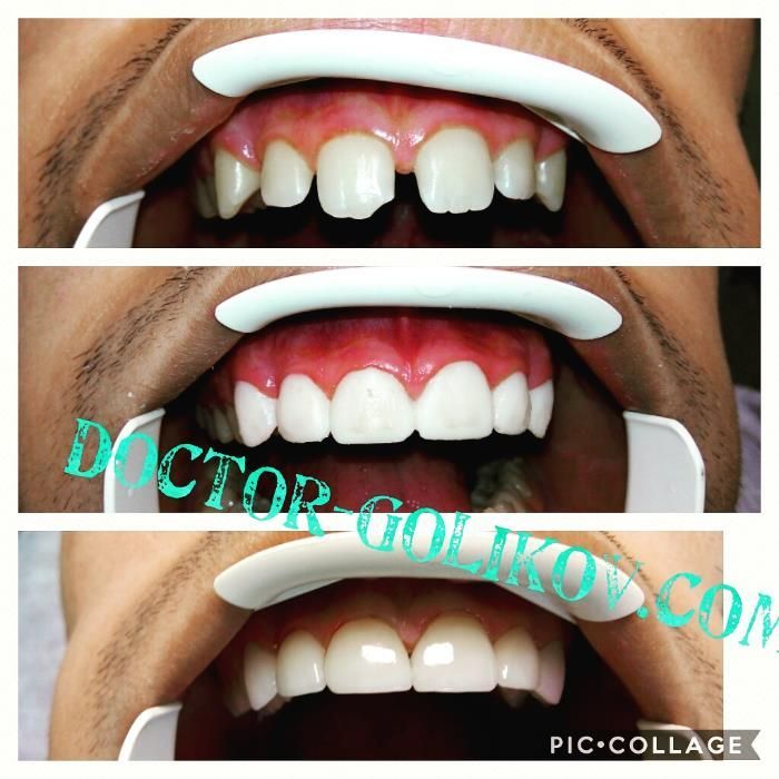 Керамічні вініри. Київ, 13500 грн . Акція! ВСЕ ВКЛЮЧЕНО!!! Е.max