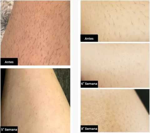 Depiladora a laser IPL