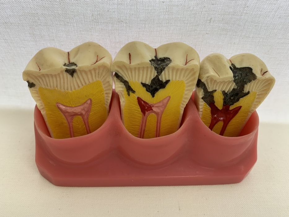 Modelo didático evolucão caries