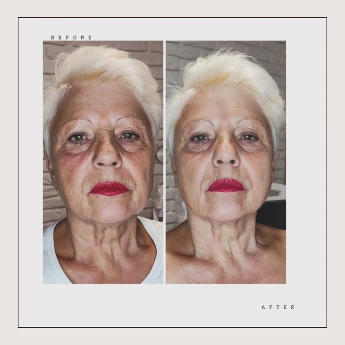 smas lifting без операційна підтяжка обличчя