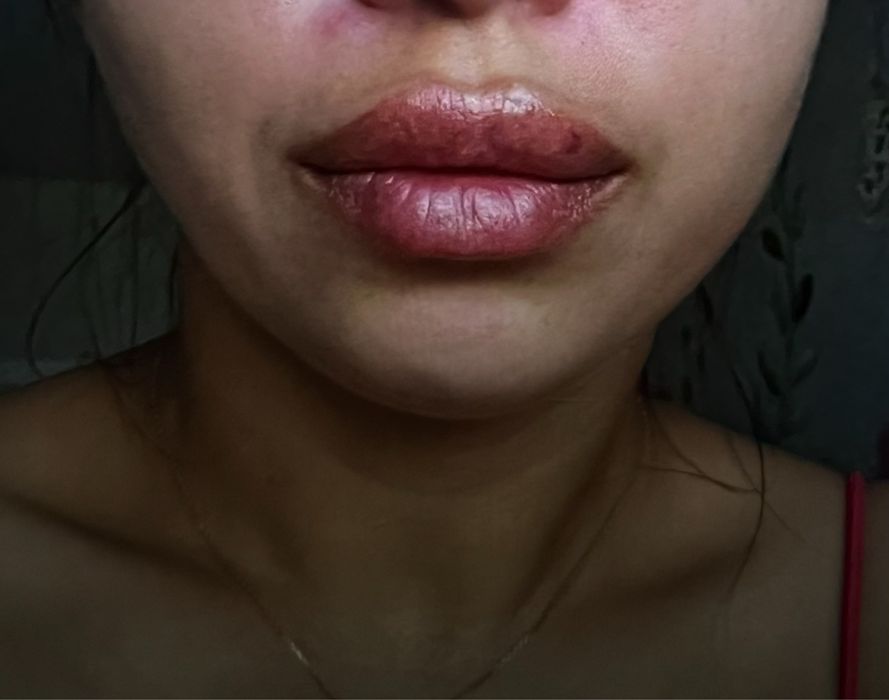 Увеличение губ 1800 грн Контурная пластика | Ботулинотерапия