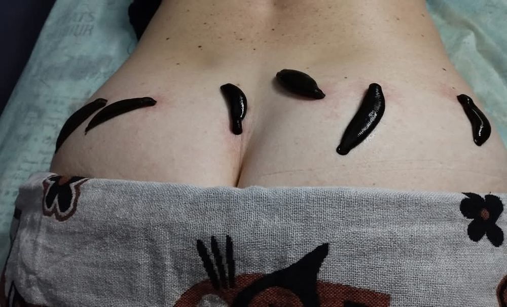 Гірудотерапія та мануальна терапія