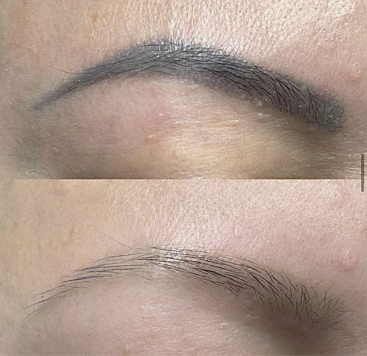 Удаление татуажа Ремувером! Качественно и эффективно!