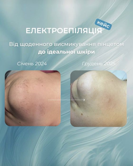 Електроепіляція,правий берег
