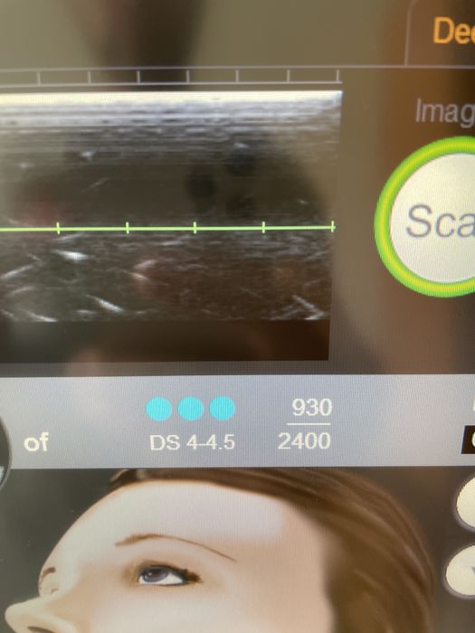 Ulthera System Альтера (original) USA аренда 18000 грн