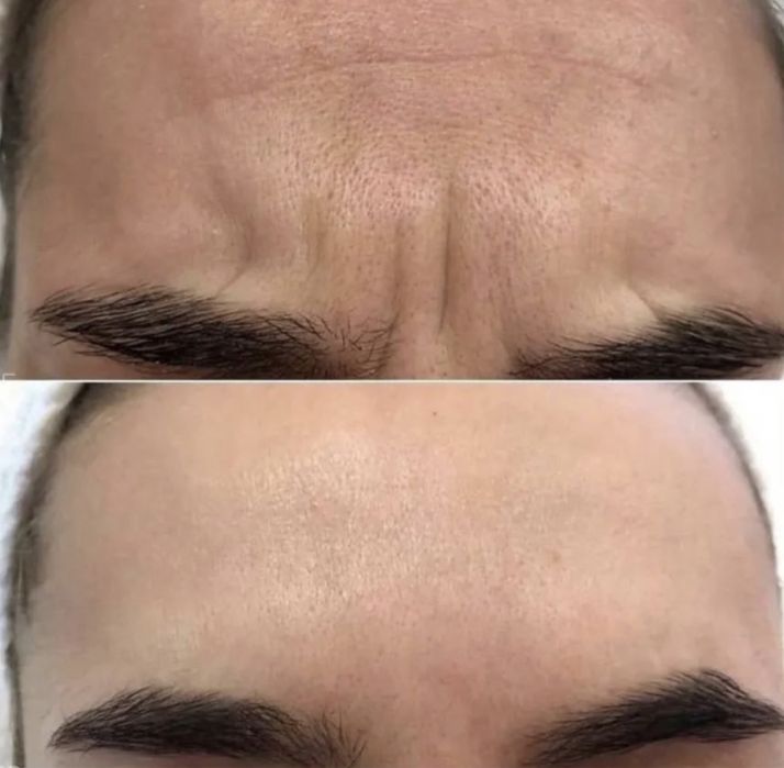 Botox Effect - usuwanie zmarszczek