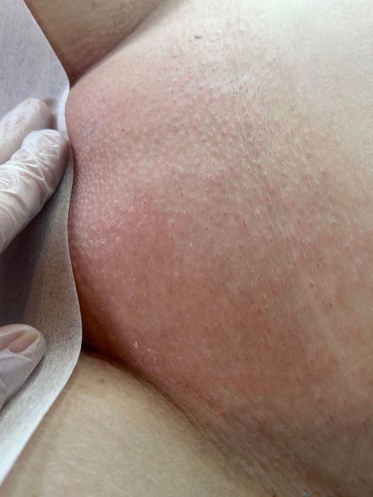 Depilacja cukrem i woskiem