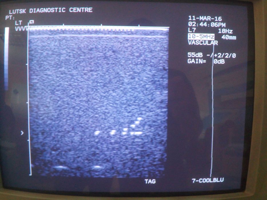 Лінійний датчик УЗД Siemens (Acuson) L7