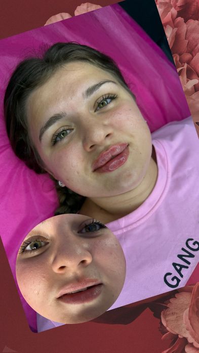 Увелечения Губ Контурная пластика