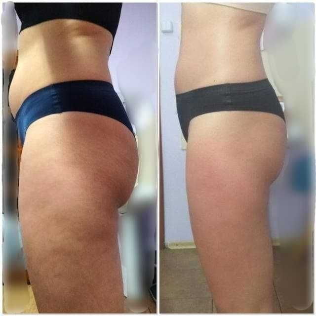 Антицеллюлитный массаж