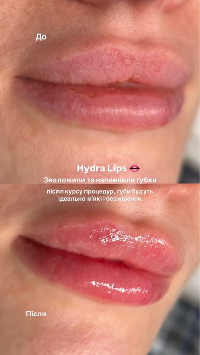 Косметолог Хмельницький | Мікронідлінг, Чистки, Догляд