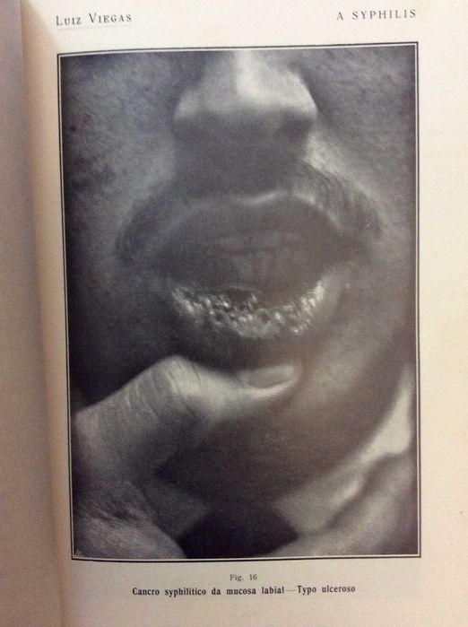 A Syphilis - Suas manifestações tegumentares. Imagens impressionantes.