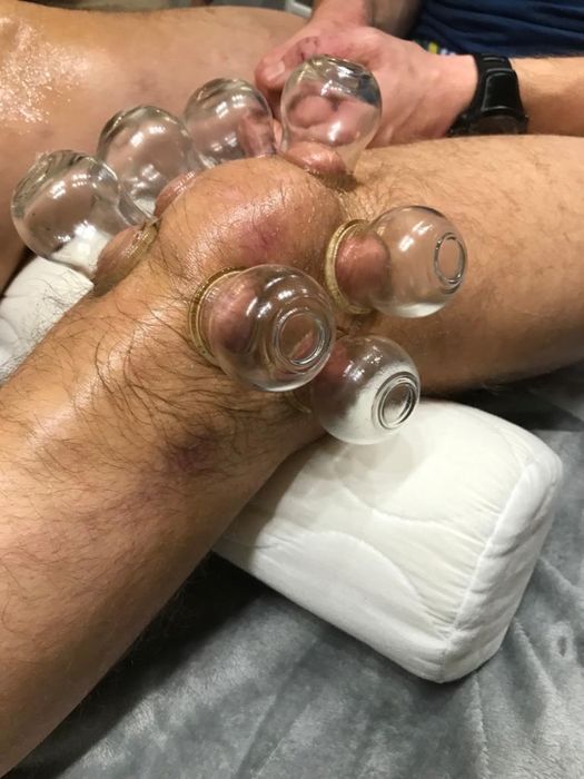 Stawianie baniek ogniowych lekarskich Dojazd do Pacjenta