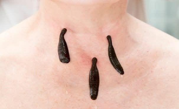 Гірудотерапія та мануальна терапія