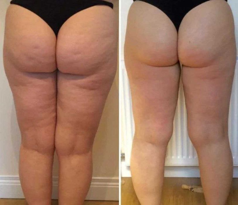 Антицелюлітний вакуумний масаж  • Апаратні методики • Масаж обличчя