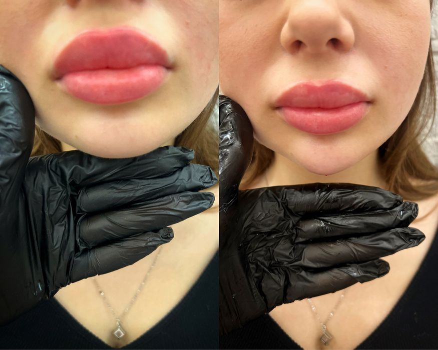 Косметолог. Губы . подбородок, углы нижней челюсти. Углы Джоли.