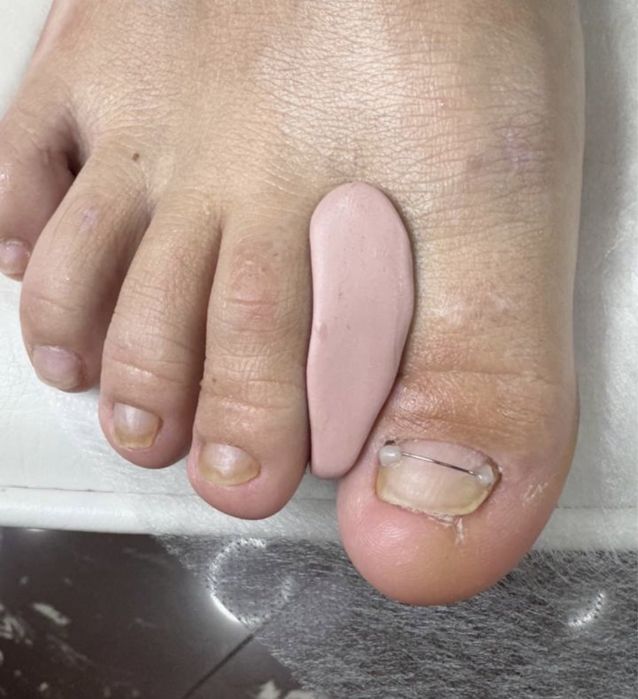 Подолог, педикюр Кривий Ріг