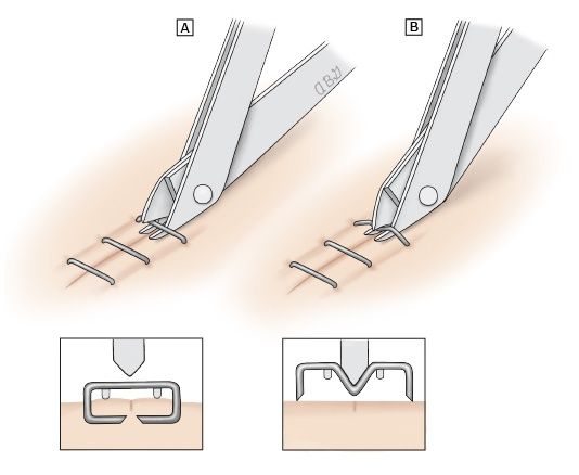 Медсестра зняття швів , шкірних  скоб ,постановка катеторів та зондів