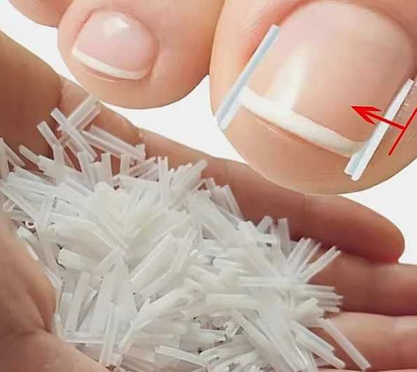 Коректор врослого нігтя (10 пластин). Лікування вдома без операції