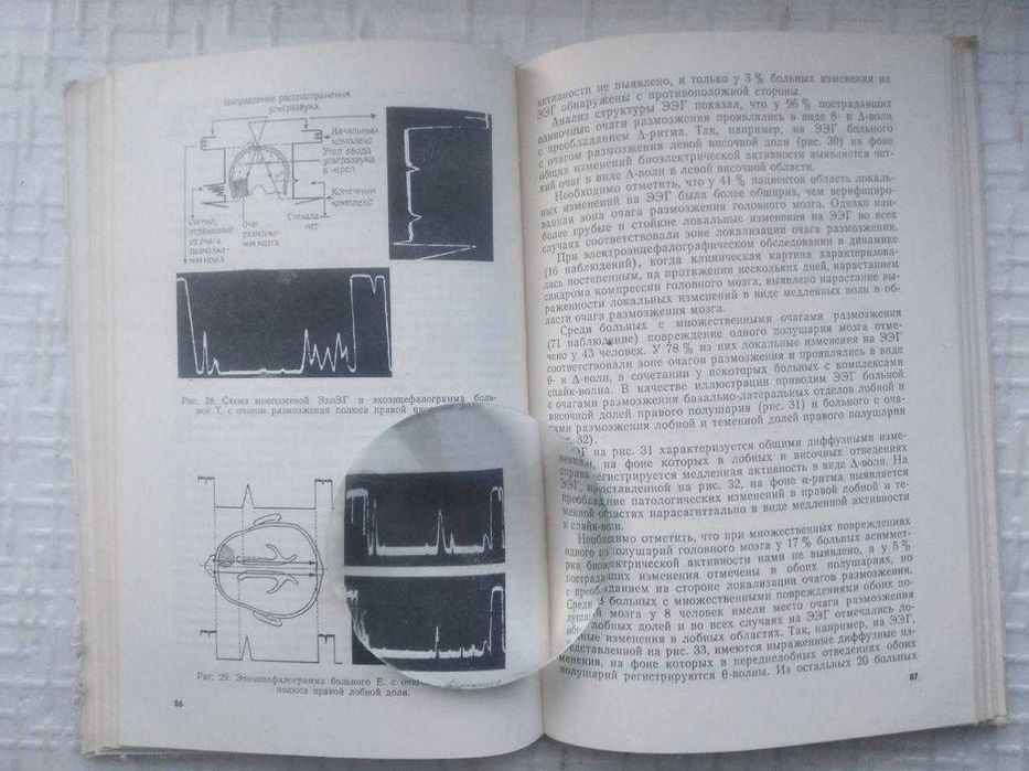 Хирургия травматических внутричерепных гематом и очагов размозжения го