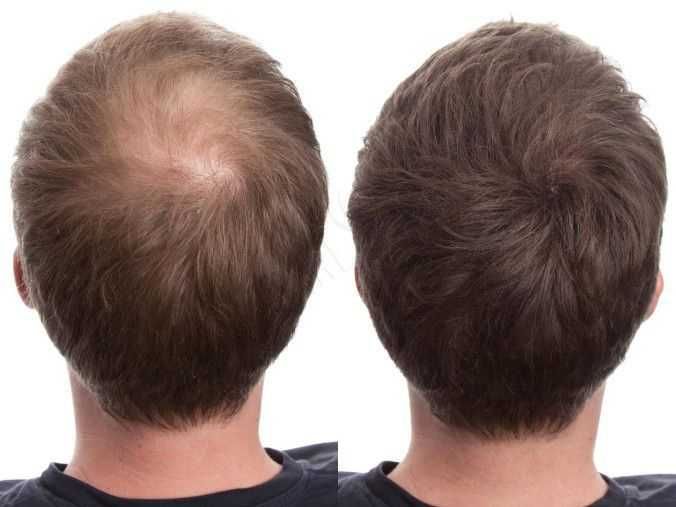 Fibras Capilares Toppik para maior Densidade capilar | Queda de Cabelo | Calvície | Calvice | Hair Building Fibers Spray
