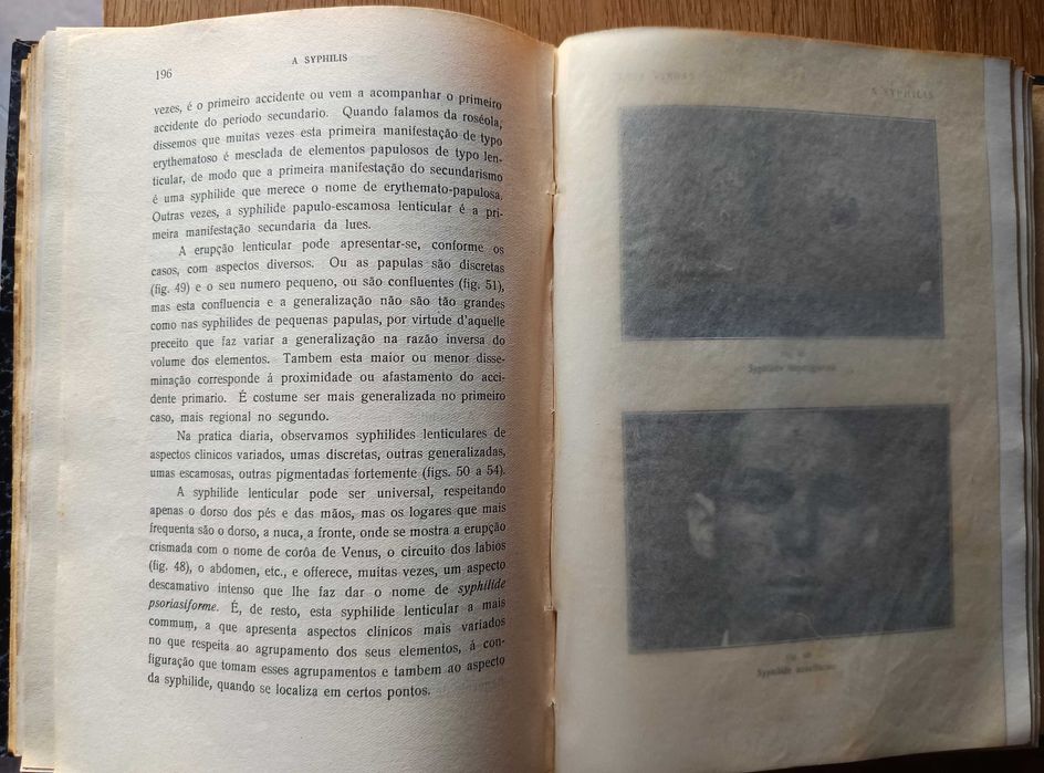 A Syphilis - Manifestações Tegumentares - Luiz de Freitas Viegas -1925