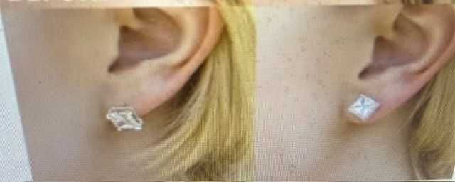 zatyczki do kolczyków  podnoszące - kolczyki