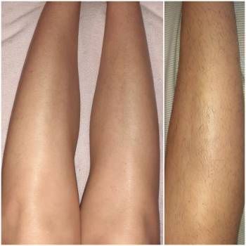 Шугаринг на дому