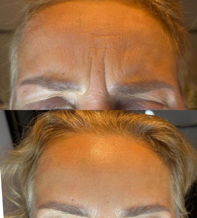 -50% BTX/ botoks/ botox/ powiększanie ust