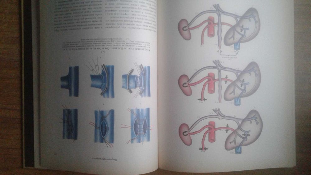 Атлас операций на печени 1975 год