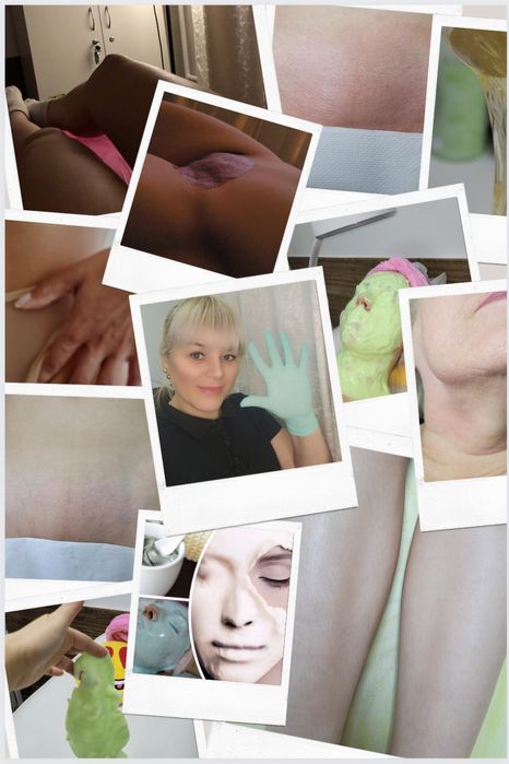 Епіляція воскова, цукрова, лікування врослого волосся