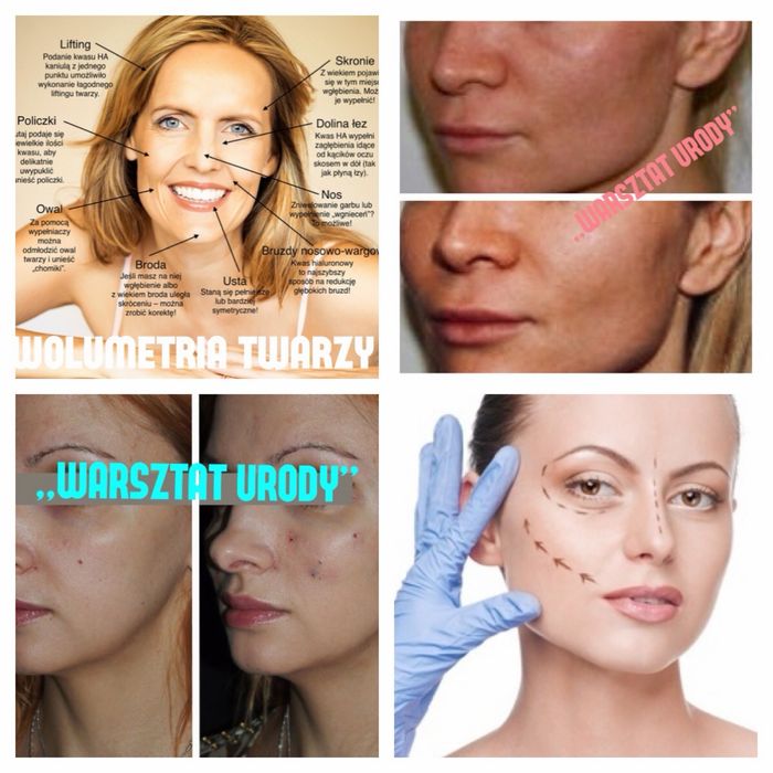 -50% POWIĘKSZANIE UST botox btx kwas hialuronowy NICI HACZYKOWE