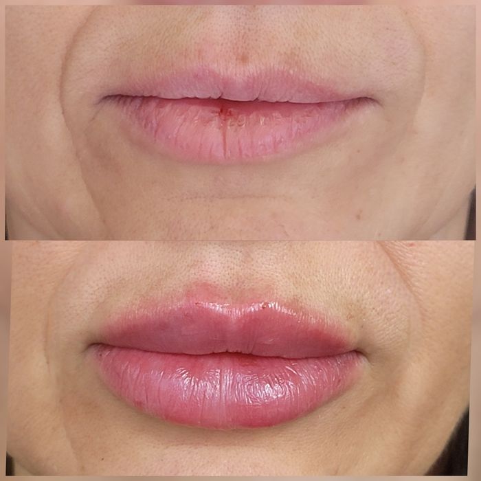 Збільшення губ КП губ Ботокс Дніпро