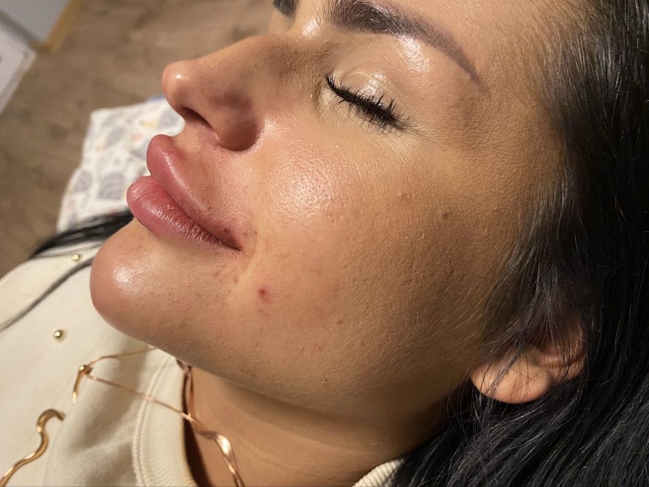 Powiększanie ust wolumetria